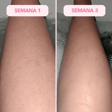 Antes y después LumiSkin 1