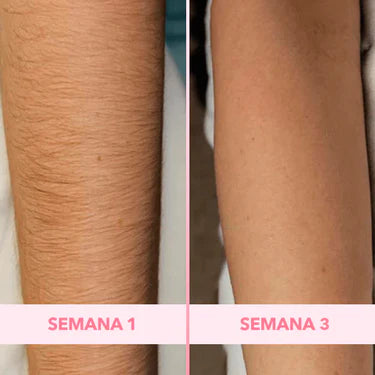 Antes y después LumiSkin 4