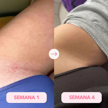 Antes y después LumiSkin 5