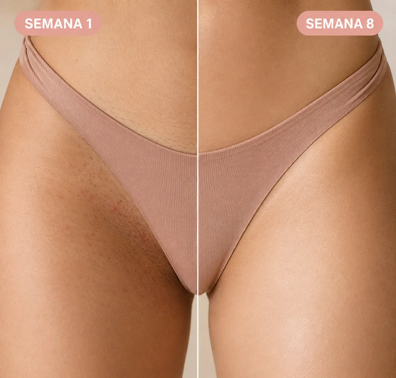 Antes y después en la zona del bikini tras 8 semanas de depilación IPL en casa