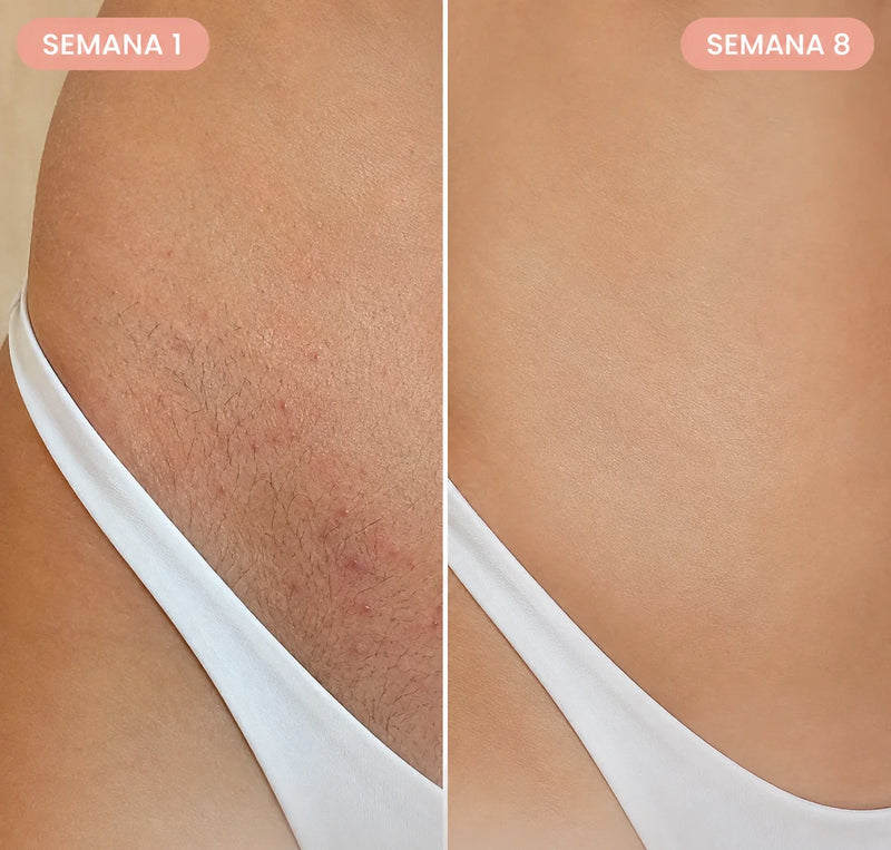 Antes y después en la ingle: piel sin irritación tras 8 semanas con LumiSkin