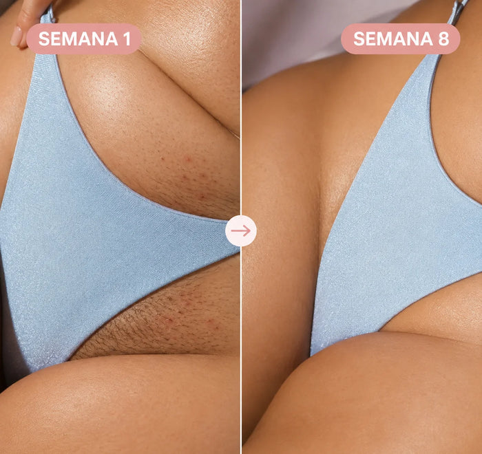 Resultado antes y después LumiSkin